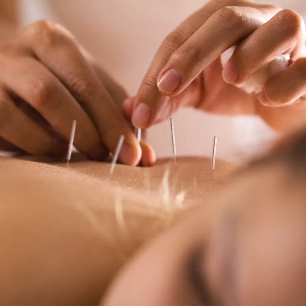 Doctor applying acupuncture treatment  