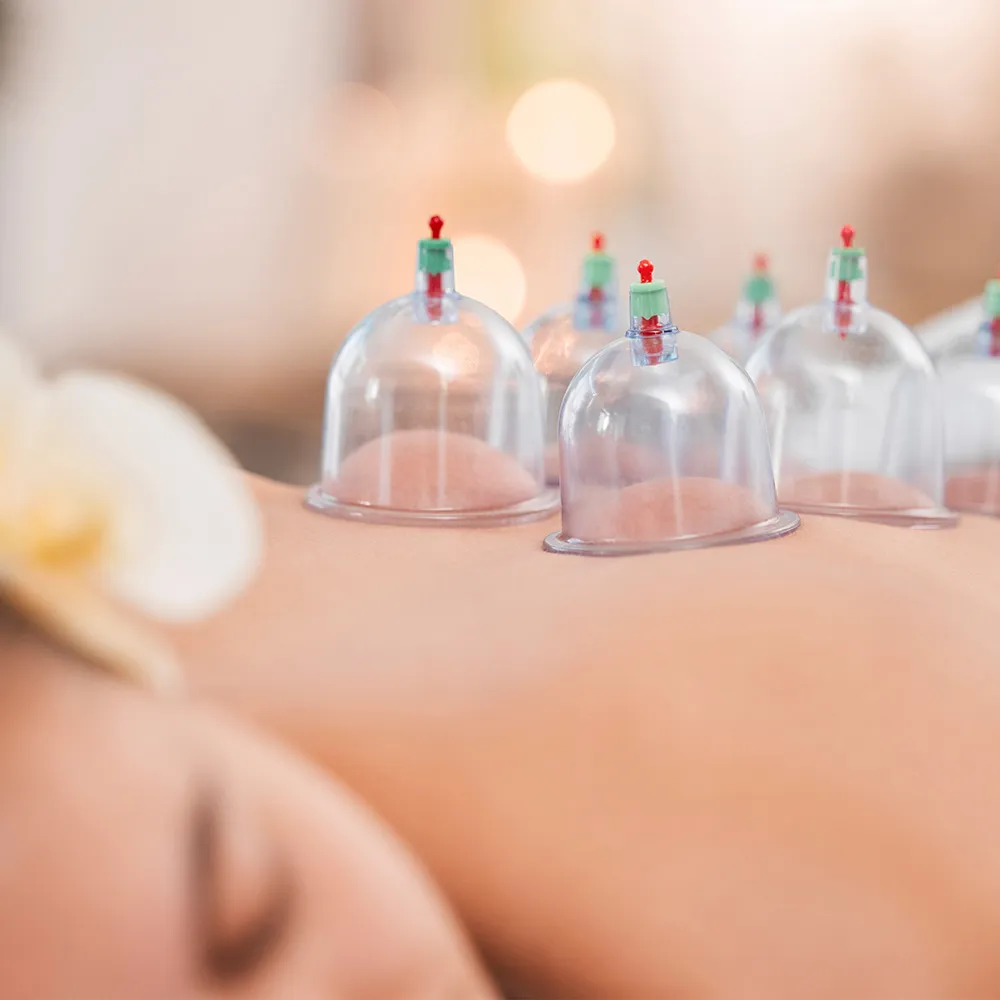Person receiving cupping therapy on back  