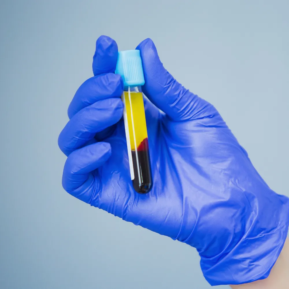 Plasma sample in laboratory tube  