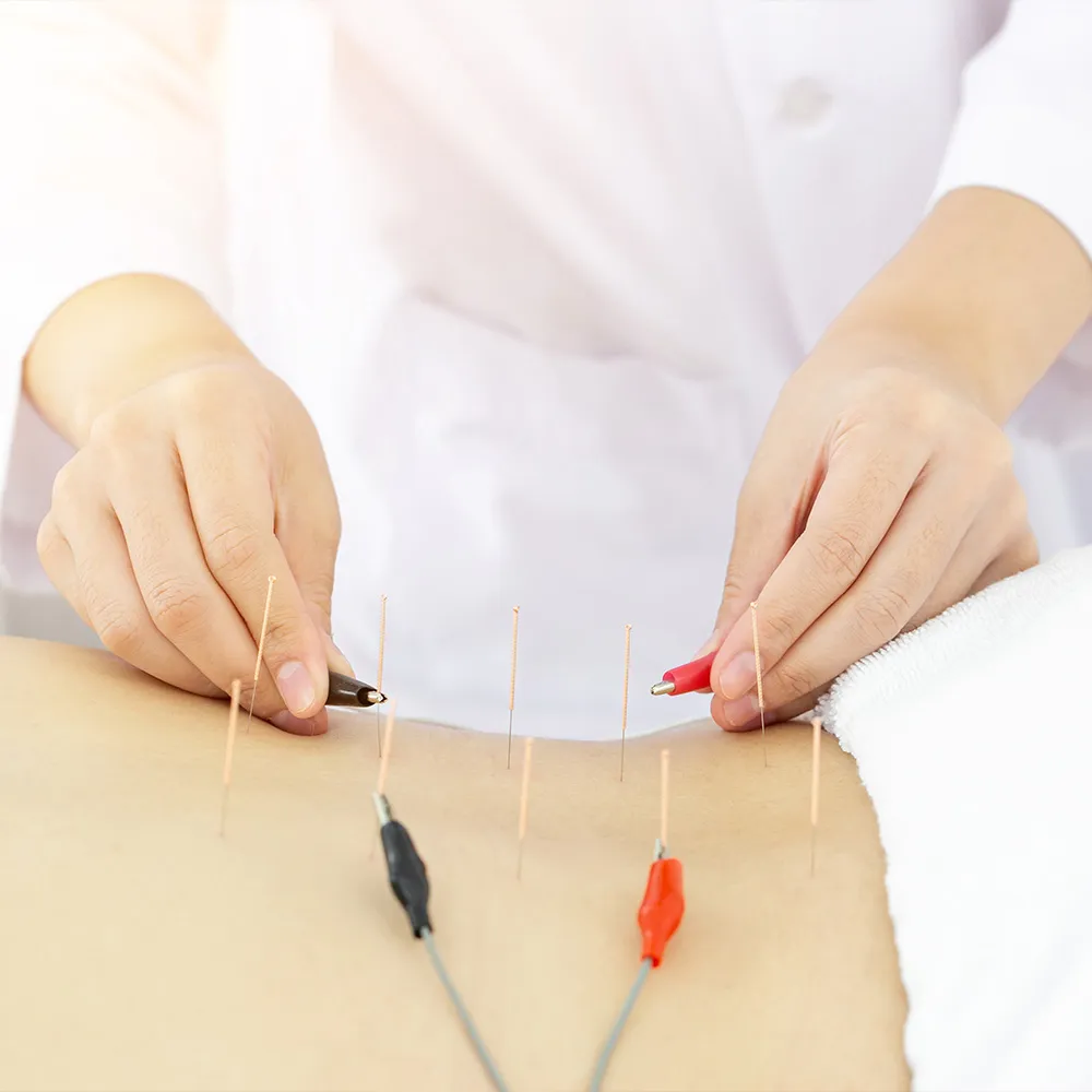 Doctor applying acupuncture with electrical stimulation  
