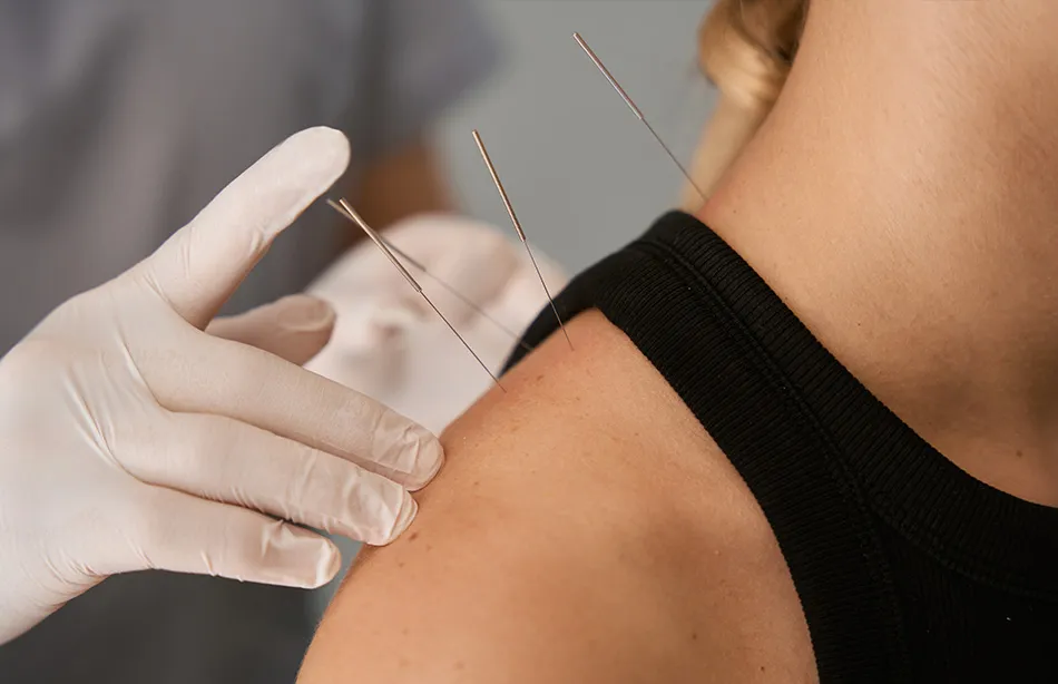 Doctor applying acupuncture